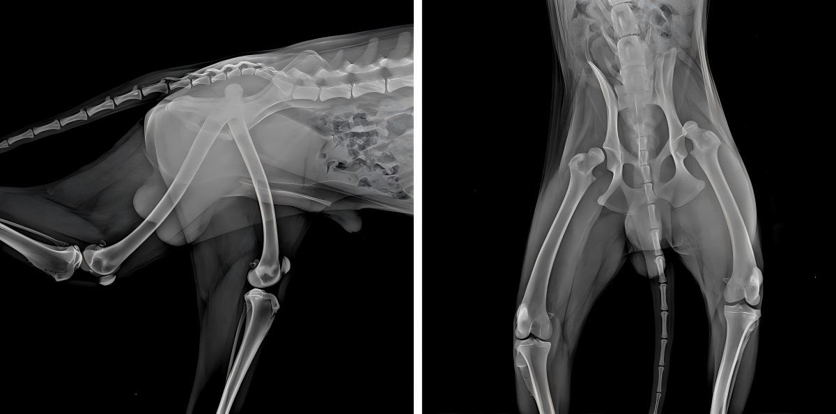 Wettermedix Udostępnianie przypadków 丨 Laser o dużej mocy poprawia pooperacyjną rehabilitację dwustronnego zwichnięcia kości udowej